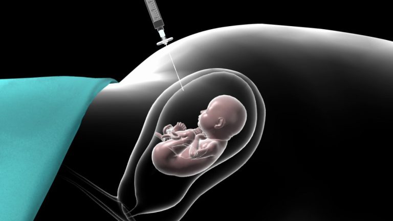 آمنیوسنتز: پنجره‌ای به دنیای سلامت جنین