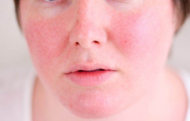 درد و رنج پوست ملتهب: علائم درماتیت اکسفولیاتیو را بشناسید